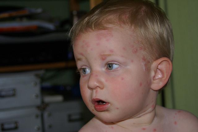 Än att behandla en kycklingpox i barnet